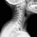 cervical spine xray